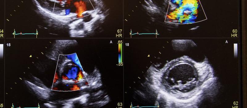 Fizyka Dopplera w ultrasonografii